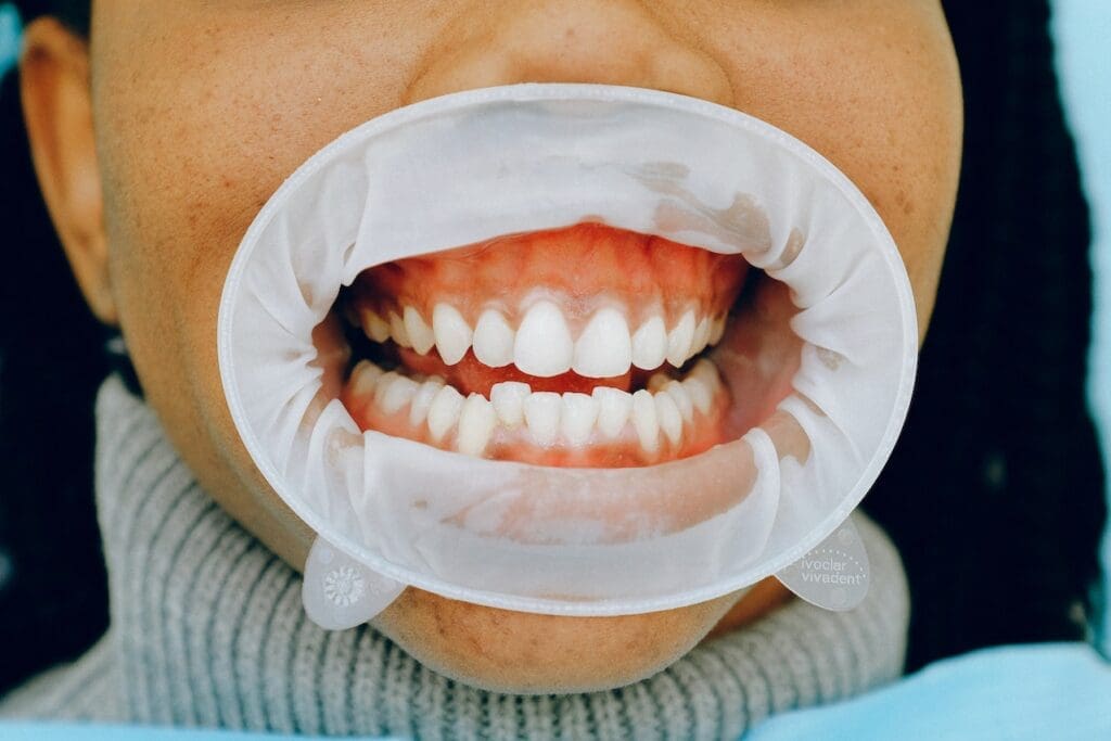 Chipped Teeth