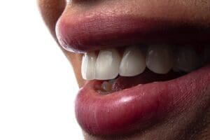 dental bridges
