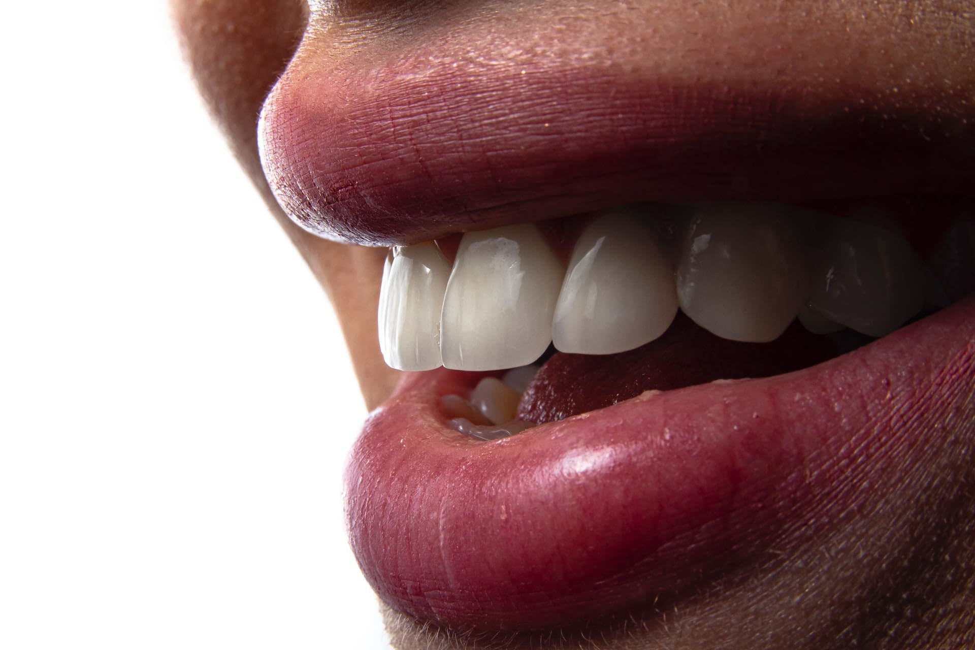 dental bridges