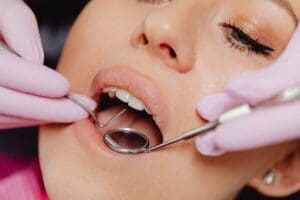 Teeth Whitening