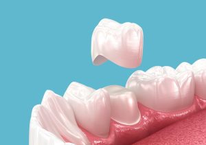 dental crown procedure what to expect
