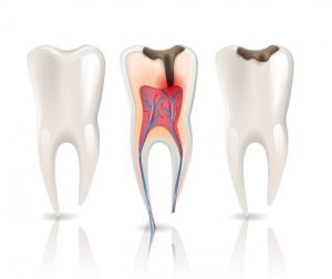 signs you might need a root canal
