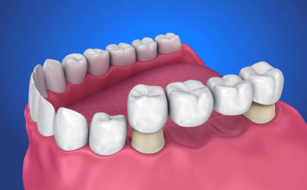 types of dental crowns which one is best for you