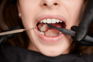 Protect your teeth from cavities with dental sealants in Weymouth—quick, effective, and ideal for kids and adults