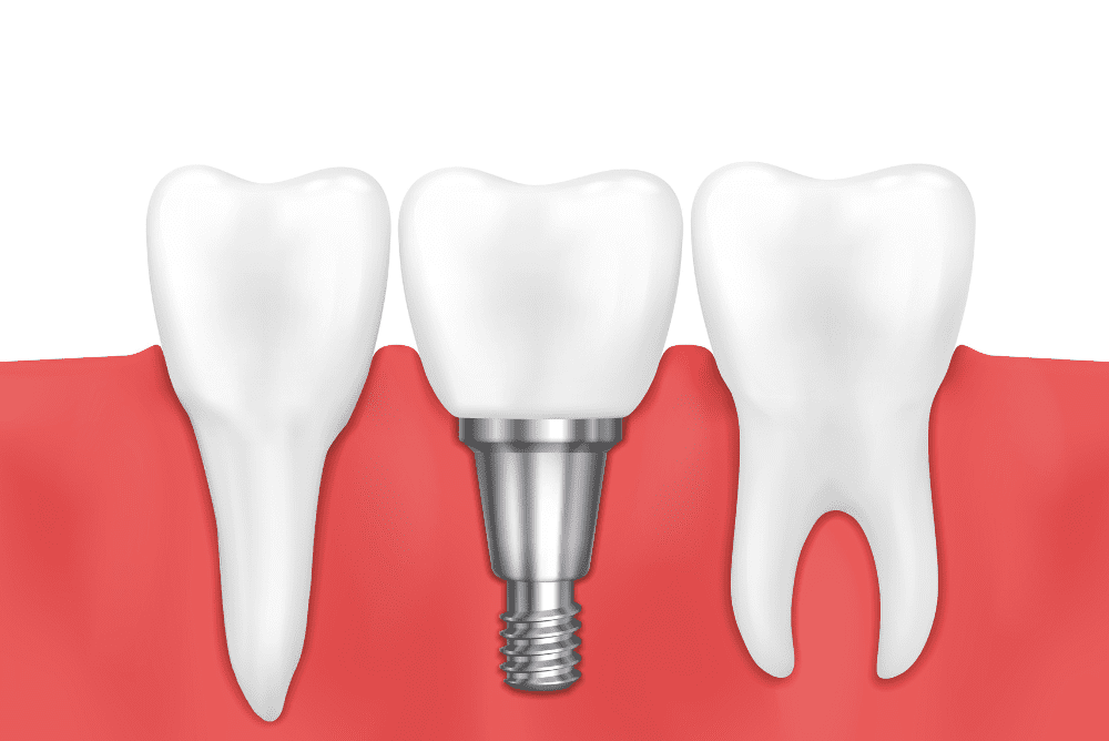 Looking for dental implants in Weymouth or dental implants near you? Weymouth Dental Arts offers lasting solutions to restore your smile with comfort and precision. Book your consultation today!