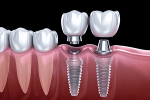 Looking for dental implants near you? Discover why dental implants in Weymouth are the most reliable solution to restore your smile, improve oral health, and boost your confidence. Learn the process, benefits, and cost options today!