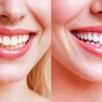How to Maintain Your Smile After Smile Makeover Treatments