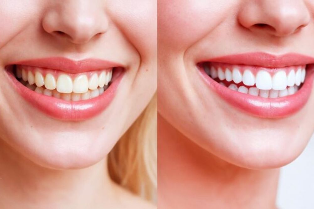 How to Maintain Your Smile After Smile Makeover Treatments