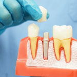 restore your smile with long-lasting dental implants