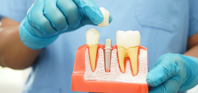 restore your smile with long-lasting dental implants
