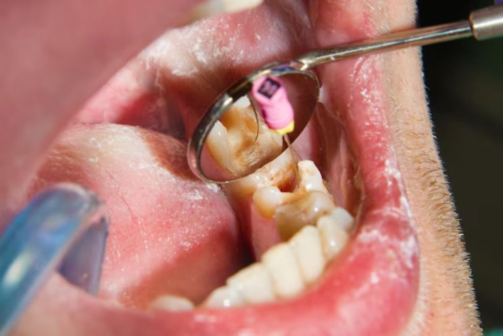 dentist placing a composite dental filling to repair tooth decay
