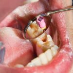 dentist placing a composite dental filling to repair tooth decay
